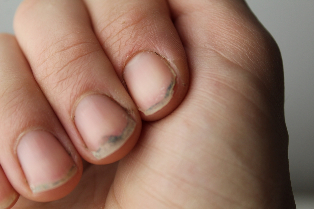 dirty nails